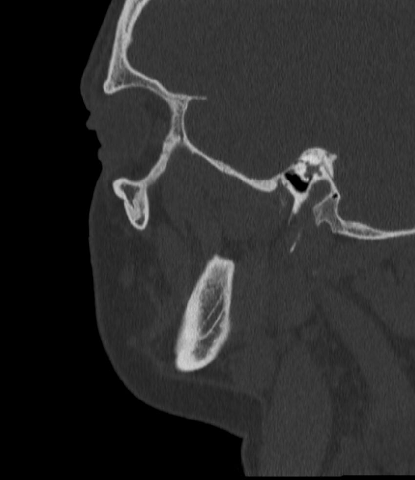 Normal facial bone CT (Radiopaedia 88742-105476 Sagittal bone window 47).jpg