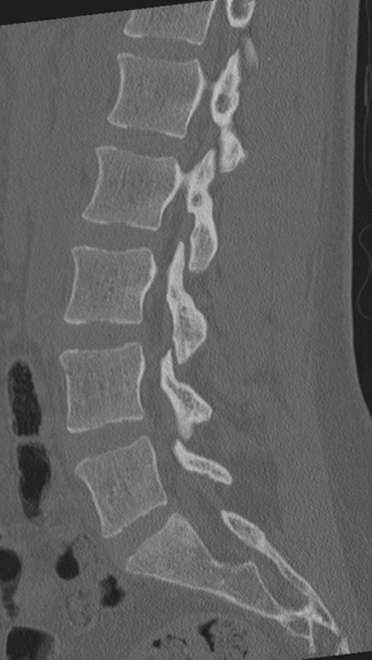 File:Normal lumbar spine CT (Radiopaedia 46533-50986 Sagittal bone window 44).png