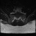Normal lumbar spine MRI (Radiopaedia 47857-52609 Axial T2 33).jpg
