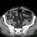 Obstructed Tenckhoff peritoneal dialysis catheter (Radiopaedia 37858-39789 Axial non-contrast 2).jpg