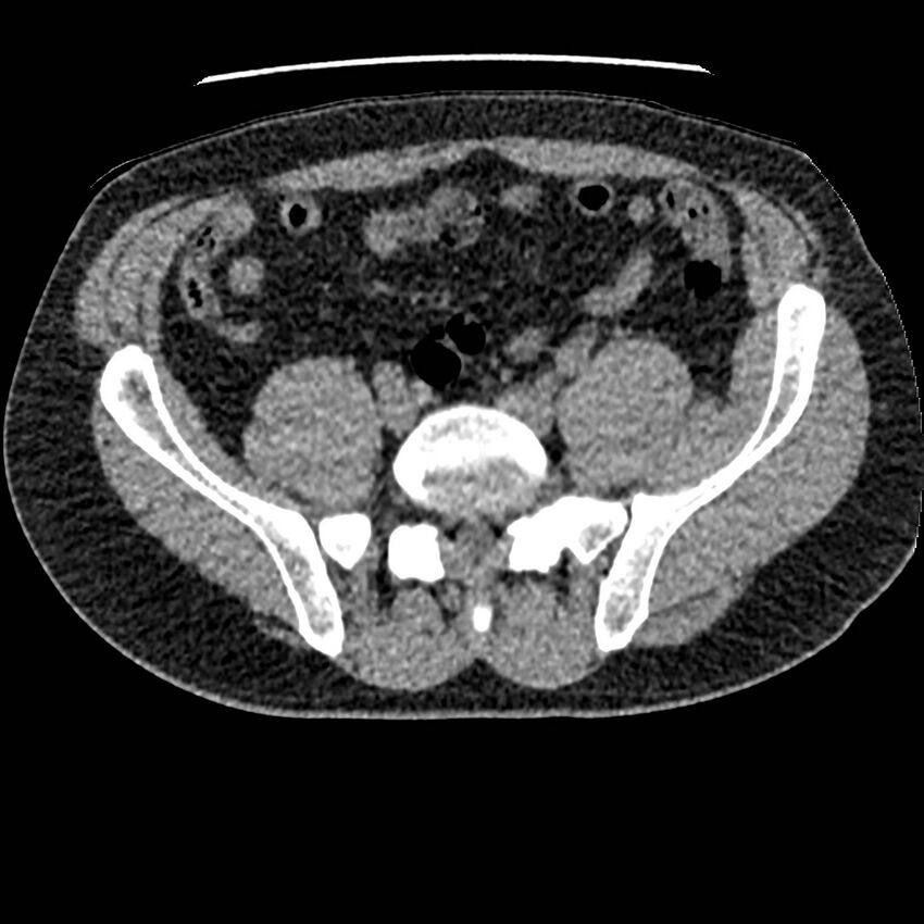 Obstructing ureteric calculus and ureteric anatomy (Radiopaedia 62730-71042 Axial non-contrast 108).jpg