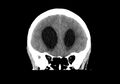Obstructive hydrocephalus (Radiopaedia 30453-31119 Coronal non-contrast 12).jpg