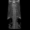 Occipital condyle fracture (Radiopaedia 31755-32691 Coronal bone window 11).jpg