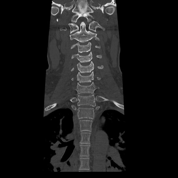 File:Occipital condyle fracture (Radiopaedia 31755-32691 Coronal bone window 11).jpg