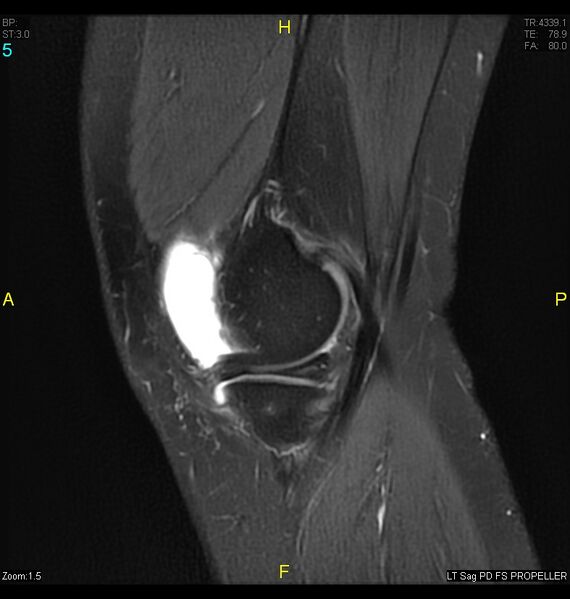 File:ACL mucoid degeration with cystic changes (Radiopaedia 48428-53341 Sagittal PD fat sat 3).jpg
