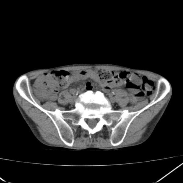 File:Abdominal aortic aneurysm (Radiopaedia 23703-23856 Axial non-contrast 41).jpg