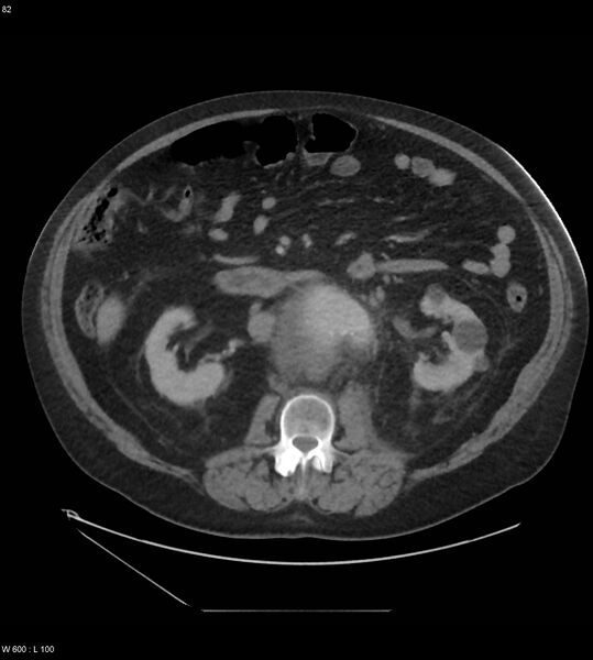 File:Abdominal aortic aneurysm with intramural hematoma then rupture (Radiopaedia 50278-55631 Axial C+ arterial phase 73).jpg