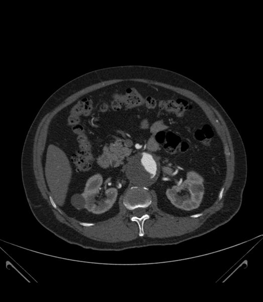 File:Abdominal aortic aneurysm with thrombus fissuration (Radiopaedia 46218-50618 Axial C+ arterial phase 14).jpg