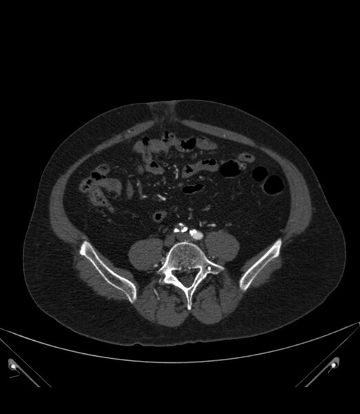 File:Abdominal aortic aneurysm with thrombus fissuration (Radiopaedia 46218-50618 Axial C+ arterial phase 28).jpg