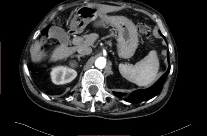 Abdominal aortic interposition tube graft and aneurysm thrombosis (Radiopaedia 71438-81857 Axial C+ arterial phase 14).jpg