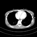 Abdominal multi-trauma - devascularised kidney and liver, spleen and pancreatic lacerations (Radiopaedia 34984-36486 Axial C+ portal venous phase 2).png