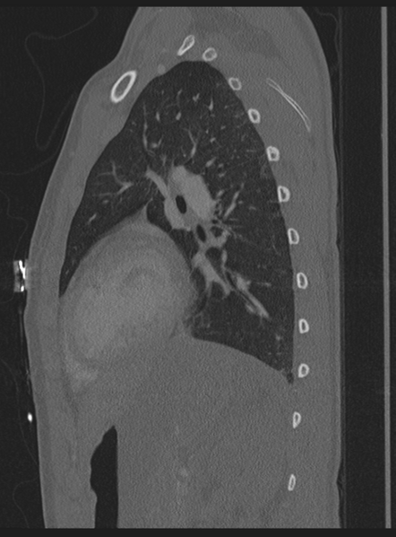 File:Abdominal multi-trauma - devascularised kidney and liver, spleen and pancreatic lacerations (Radiopaedia 34984-36486 Sagittal bone window 6).png