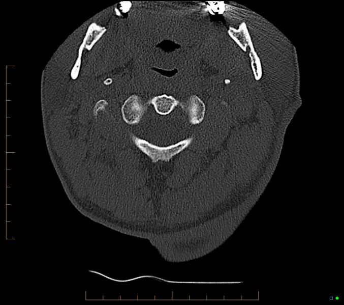 File:Accessory articulation of cervical transverse processes (Radiopaedia 82715-96933 Axial non-contrast 23).jpg