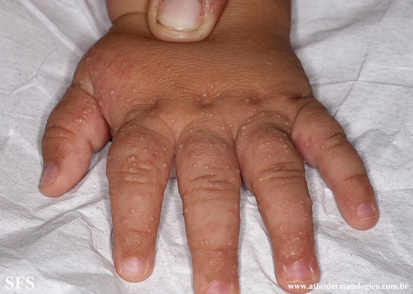 Acropustulosis Infantile (Dermatology Atlas 7).jpg