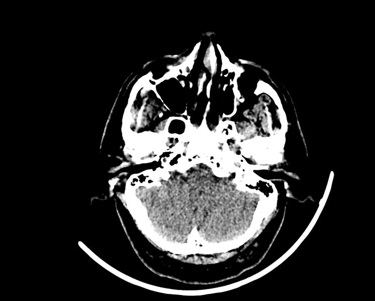 File:Acute cerebral infarct (Radiopaedia 35604-37123 Axial non-contrast 16).jpg
