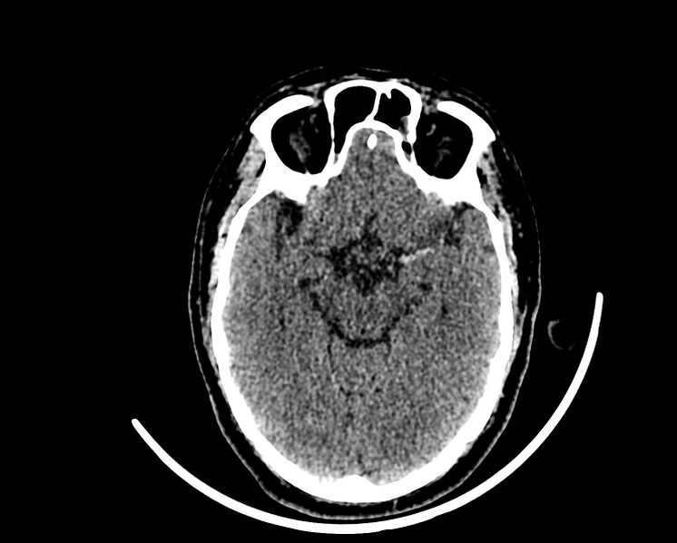 File:Acute cerebral infarct (Radiopaedia 35604-37123 Axial non-contrast 40).jpg