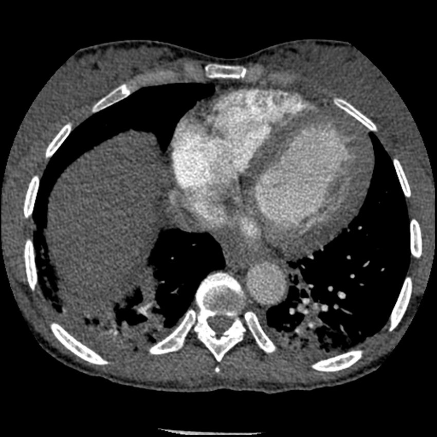 Acute chest syndrome - sickle cell disease (Radiopaedia 42375-45499 Axial C+ CTPA 139).jpg