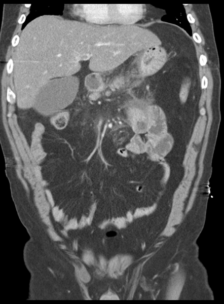 File:Acute pancreatitis complicated by portal vein thrombus (Radiopaedia 48148-52990 Coronal C+ portal venous phase 25).png