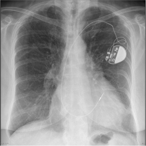 File:Acute pulmonary edema (Radiopaedia 15434-15205 Frontal 1).jpg