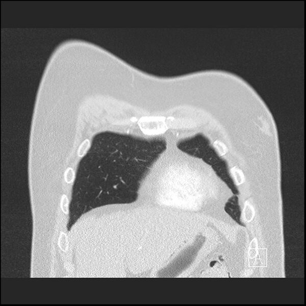 File:Acute pulmonary embolism with pulmonary infarct (Radiopaedia 73062-83768 Coronal lung window 10).jpg