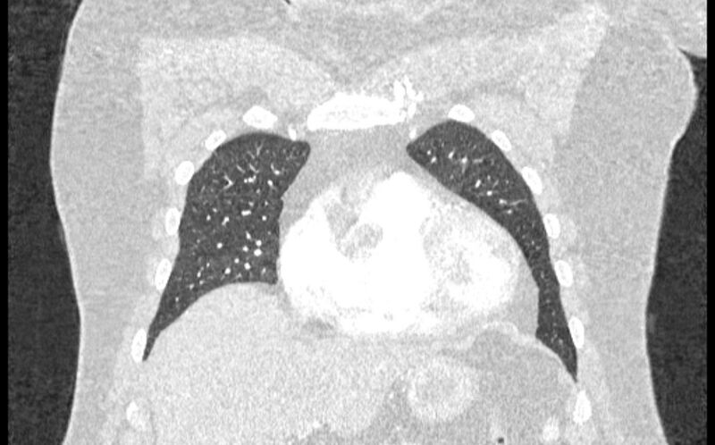 File:Acute pulmonary embolism with pulmonary infarcts (Radiopaedia 77688-89908 Coronal lung window 13).jpg
