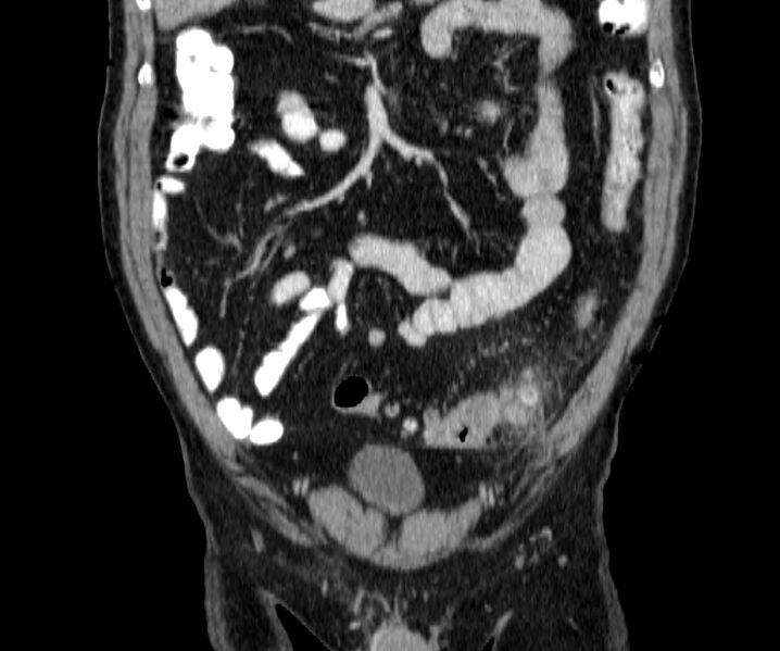File:Acute sigmoid colon diverticulitis (Radiopaedia 55507-61976 Coronal C+ portal venous phase 39).jpg