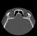 Acute sinusitis (Radiopaedia 23161-23215 Axial bone window 62).jpg