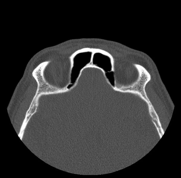 File:Acute sinusitis (Radiopaedia 23161-23215 Axial bone window 62).jpg