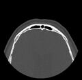 Acute sinusitis (Radiopaedia 23161-23215 Axial bone window 76).jpg