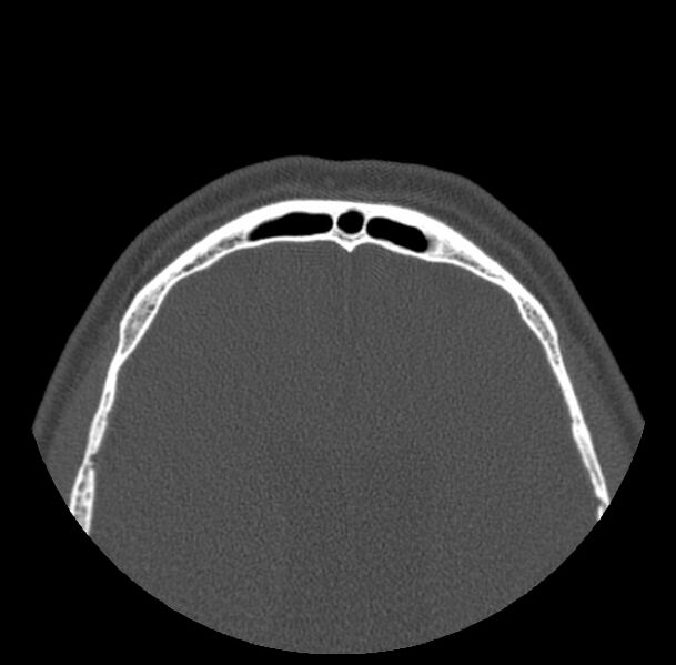 File:Acute sinusitis (Radiopaedia 23161-23215 Axial bone window 76).jpg