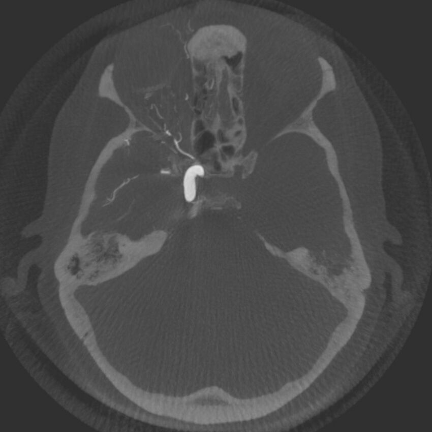 Acute subarachnoid hemorrhage and accessory anterior cerebral artery (Radiopaedia 69231-79010 Axial arterial - MIP 23).jpg