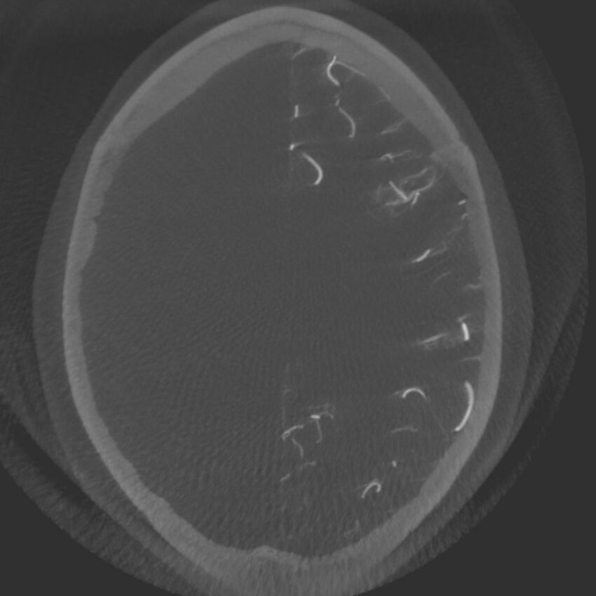 Acute subarachnoid hemorrhage and accessory anterior cerebral artery (Radiopaedia 69231-79010 C 52).jpg