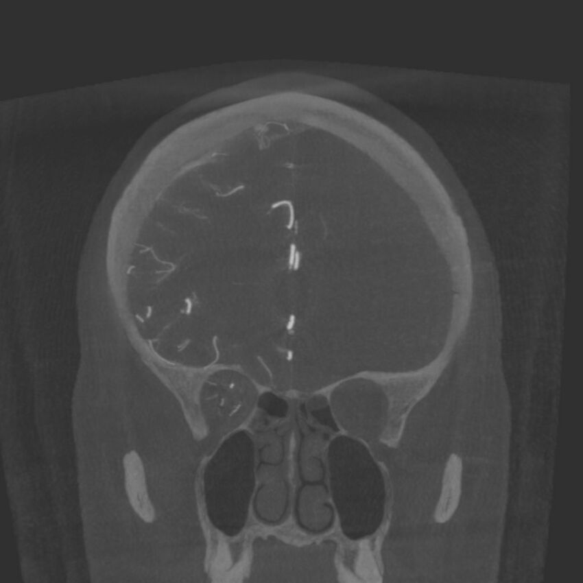 Acute subarachnoid hemorrhage and accessory anterior cerebral artery (Radiopaedia 69231-79010 Coronal arterial - MIP 28).jpg