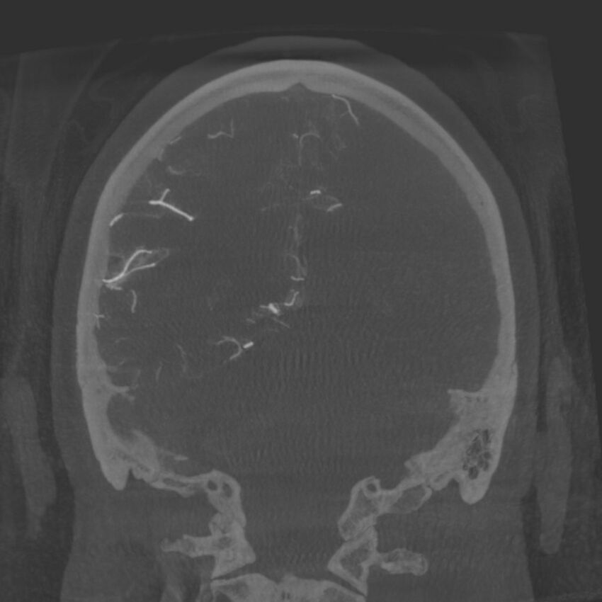 Acute subarachnoid hemorrhage and accessory anterior cerebral artery (Radiopaedia 69231-79010 Coronal arterial - MIP 73).jpg