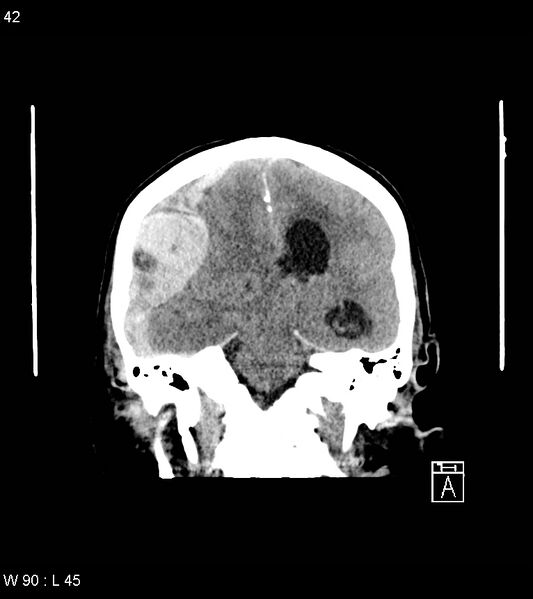 File:Acute subdural hematoma with myelofibrosis (Radiopaedia 52582-58494 Coronal non-contrast 33).jpg