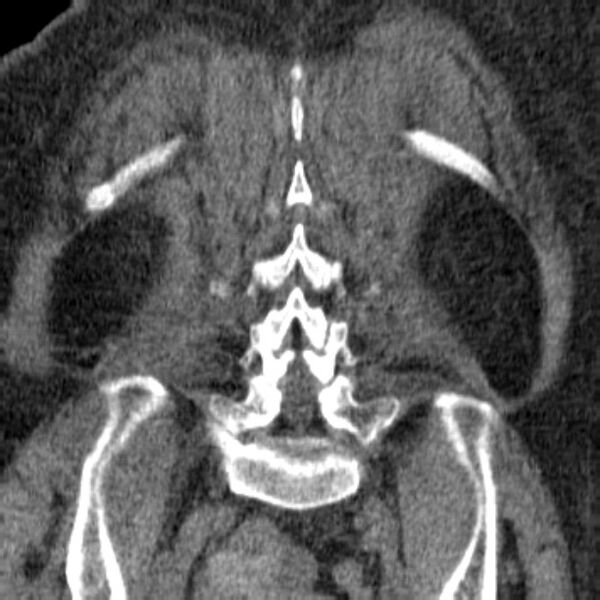 File:Acute tubular necrosis (Radiopaedia 28077-28334 Coronal non-contrast 33).jpg