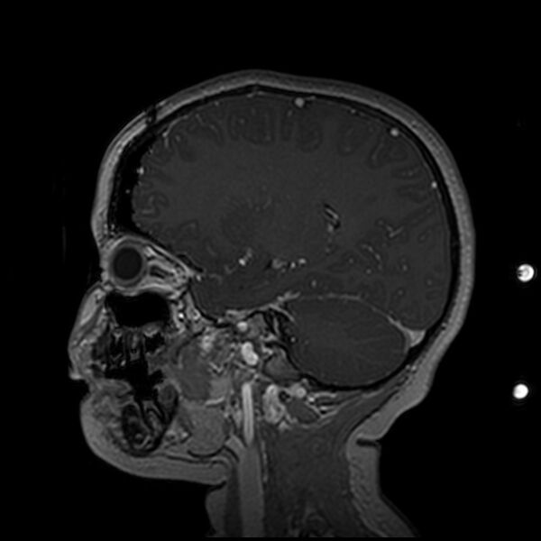 File:Adamantinomatous craniopharyngioma (Radiopaedia 77407-89529 H 44).jpg