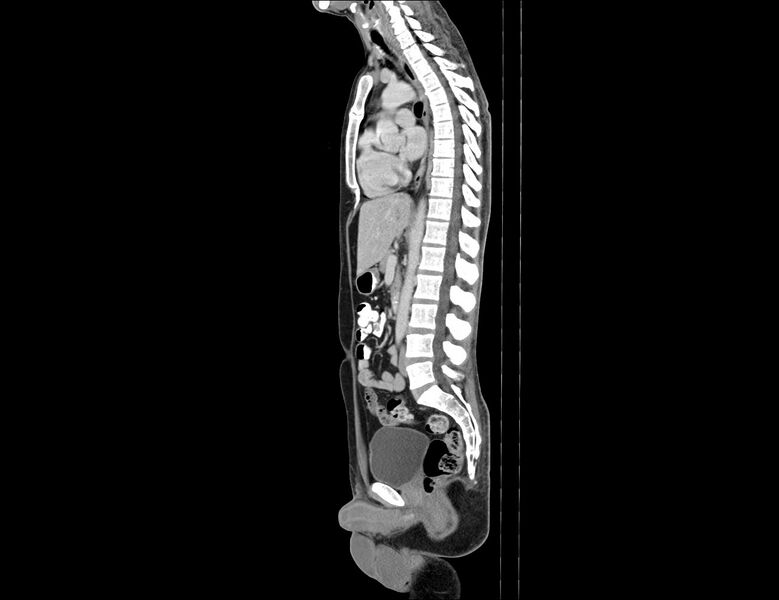 File:Addison disease (Radiopaedia 49318-54412 Sagittal C+ portal venous phase 34).jpg