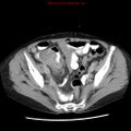 Adenocarcinoma of the colon (Radiopaedia 8191-9039 Axial renal excretory phase 48).jpg