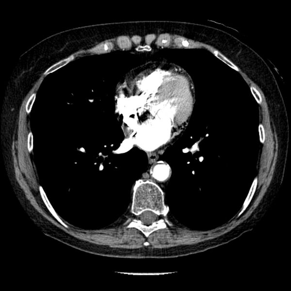File:Adenocarcinoma of the lung (Radiopaedia 41015-43755 Axial C+ portal venous phase 76).jpg
