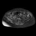 Adenomyoma of the uterus (huge) (Radiopaedia 9870-10438 Axial T1 fat sat 27).jpg