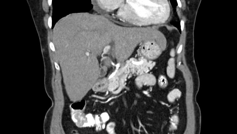 File:Adenomyomatosis of the gallbladder (Radiopaedia 12142-12483 Coronal C+ arterial phase 15).jpg