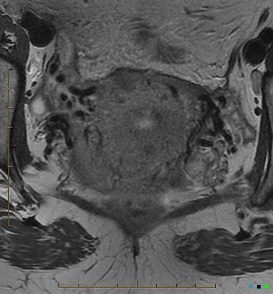 File:Adenomyosis uterus with hematometra (Radiopaedia 45779-50011 Axial T2 20).jpg