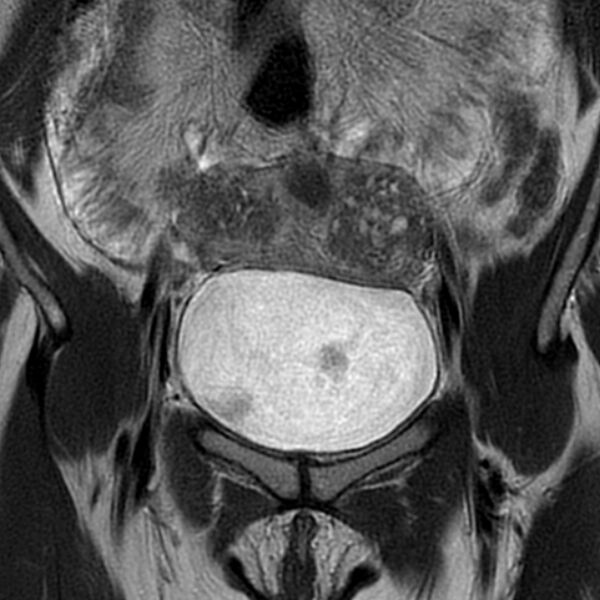 File:Adenomyosis within a septate uterus (Radiopaedia 69963-79981 Coronal T2 6).jpg