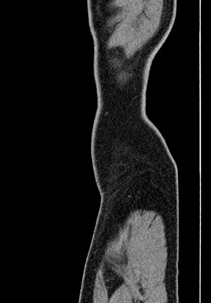File:Adhesional small bowel obstruction (Radiopaedia 58900-66131 Sagittal C+ portal venous phase 6).jpg