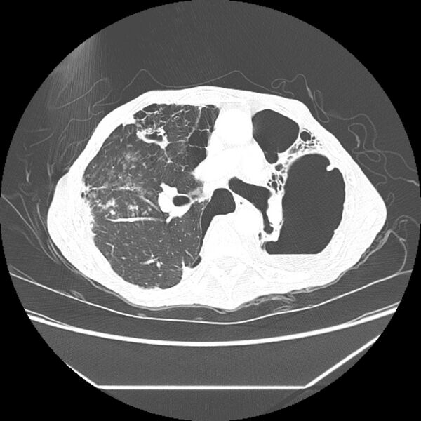 File:Advanced pulmonary tuberculosis (Radiopaedia 8599-9431 Axial lung window 23).jpg