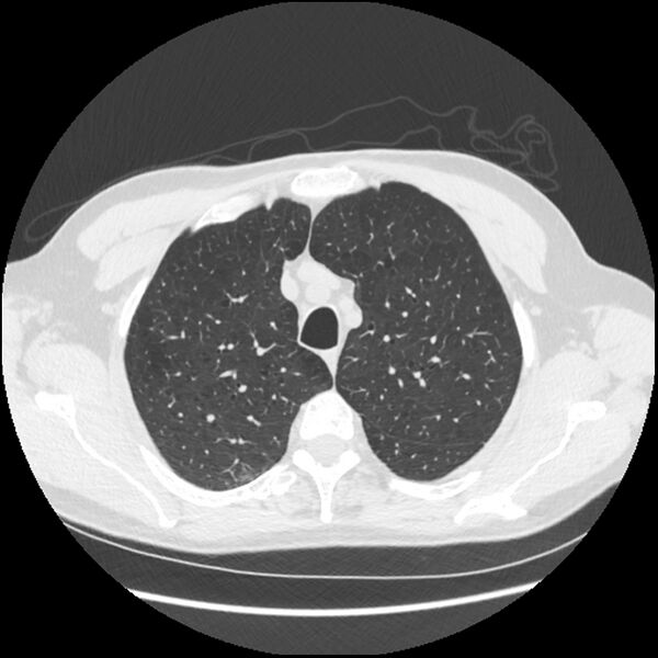 File:Alpha-1-antitrypsin deficiency (Radiopaedia 40993-43722 Axial lung window 44).jpg