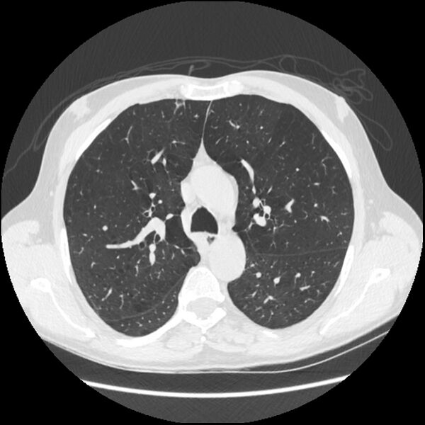 File:Alpha-1-antitrypsin deficiency (Radiopaedia 40993-43722 Axial lung window 81).jpg