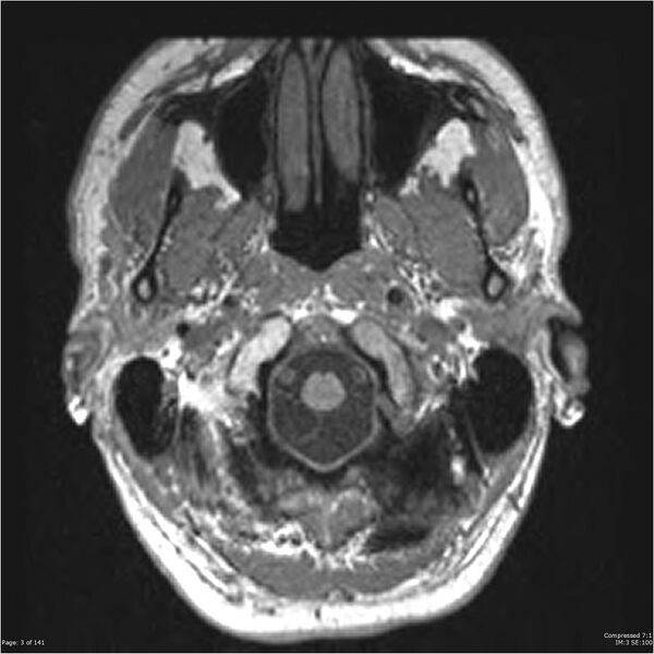 File:Anaplastic meningioma with recurrence (Radiopaedia 34452-35788 Axial T1 1).jpg