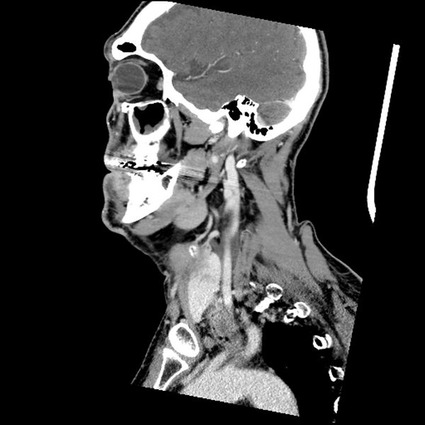 File:Anaplastic thyroid carcinoma (Radiopaedia 79087-92034 C 66).jpg